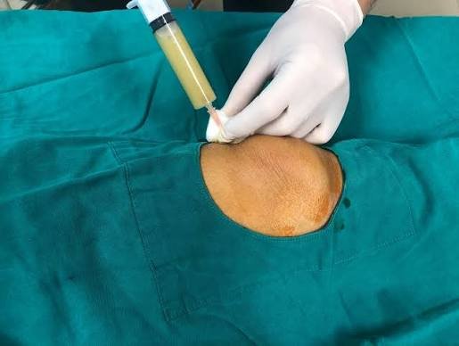 Infiammazione al ginocchio: sintomi, cause e cosa fare